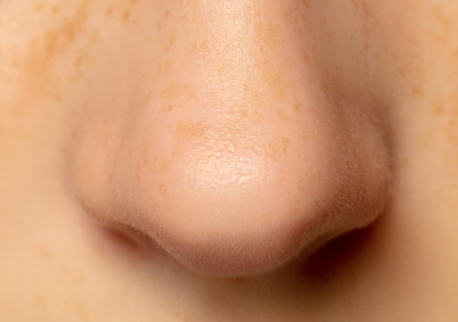 nose acne